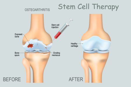 stem-cell Knee Pain Treatment